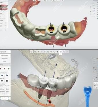 麦格口腔3D数字化引导种植技术优势