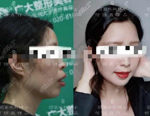 广州广大医院露龈笑矫正真人实例