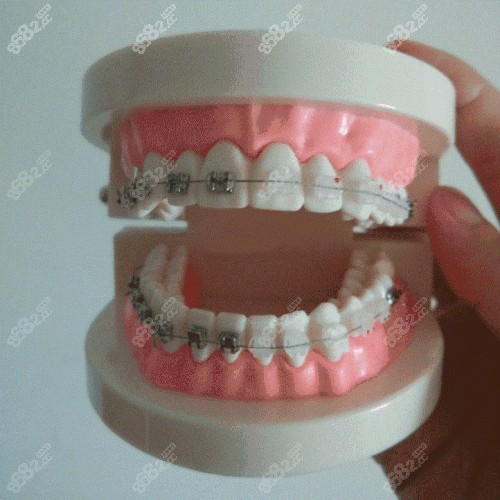 牙博士矫正牙齿大概多少钱