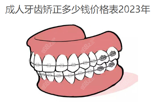 成人牙齿矫正多少钱价格表2025年隐形矫正14000+钢丝牙套5000(图1)