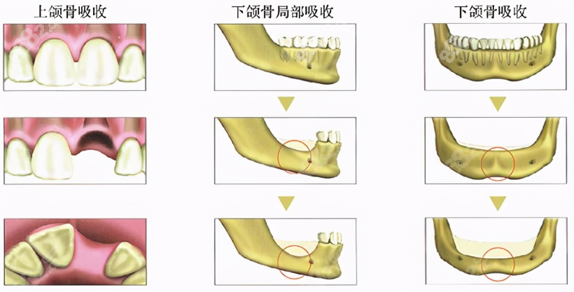 牙槽骨高度和宽度多少可以做种植牙