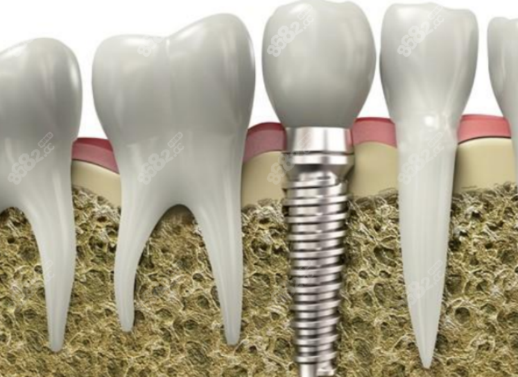 口腔医院种植牙