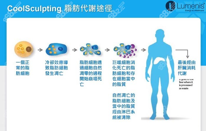 酷塑冷冻减脂的流程