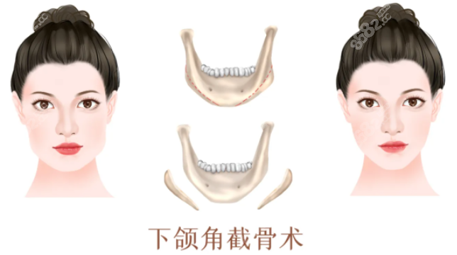 郑康在下颌角截骨技术怎么样