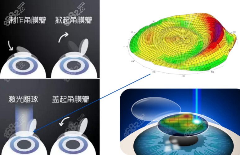 2023近视眼手术价钱一般多少