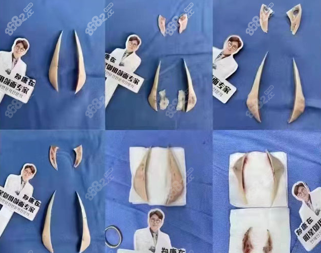 郑康在医生磨骨特点