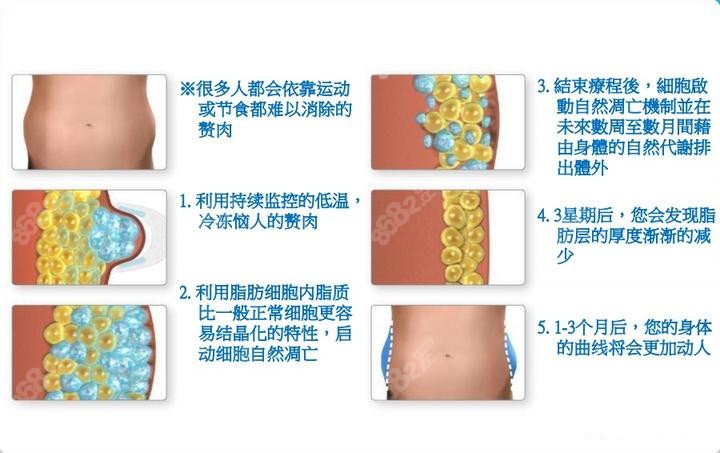 酷塑冷冻溶脂16个点位的手术原理8682.cc