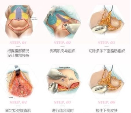 腹壁整形属于大手术吗www.8682.cc