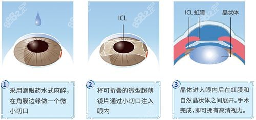 国内近视手术价格一览表2023中有晶体植入价格m.8682.cc