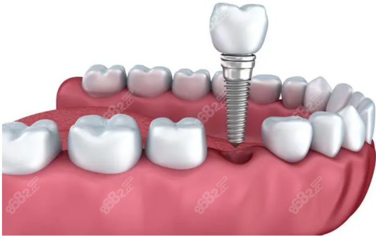 广州曙光口腔医院种植牙