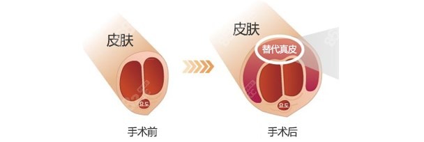 韩国世檀塔男科医院增粗图片