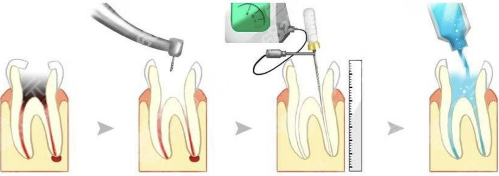 广州广大口腔医院根管治疗流程