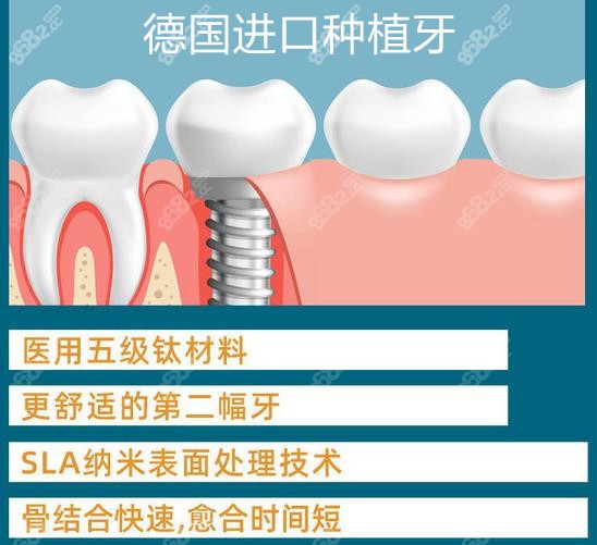 石狮中端进口种植牙价格是多少钱