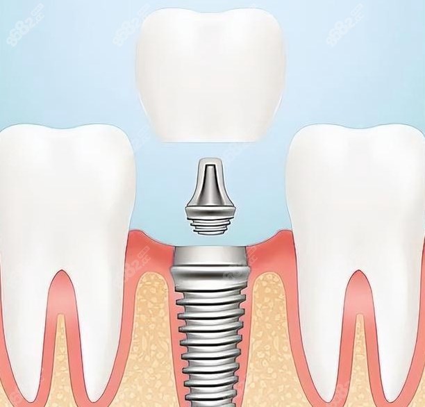 平顶山口腔医院种植牙单颗
