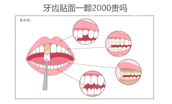 牙齿贴面一颗2025贵吗