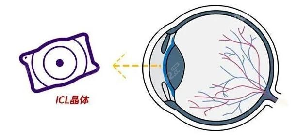 西安晶体植入近视眼手术价格