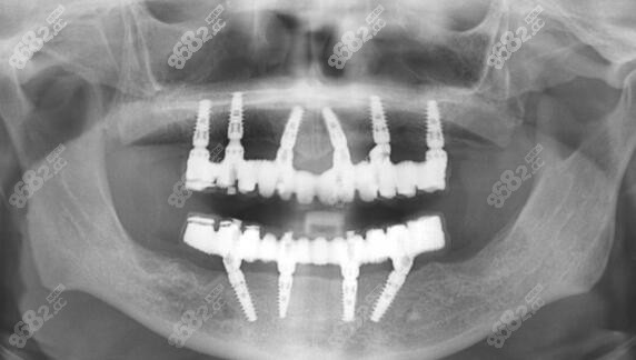 拜博口腔做全口种植牙好