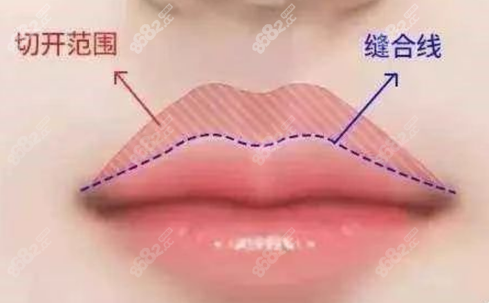 人中缩短手术唇上切口图解