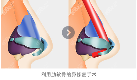 韩国431金载勋鼻修复真好@8682.cc