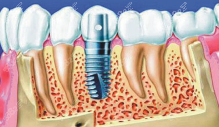 半口牙种植大约多少钱2023年价格表