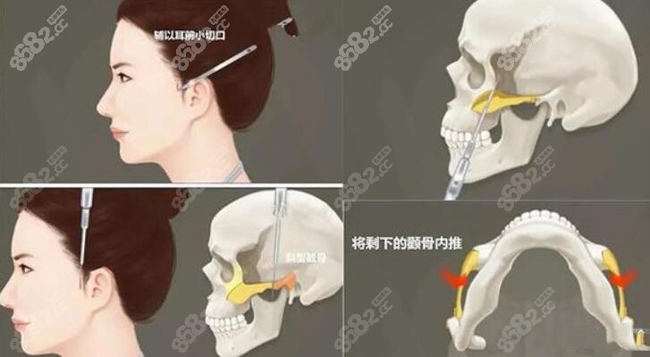 颧骨手术示意图