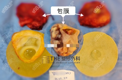 韩国THE整形外科隆胸优势介绍