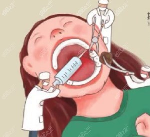 拔牙多少钱