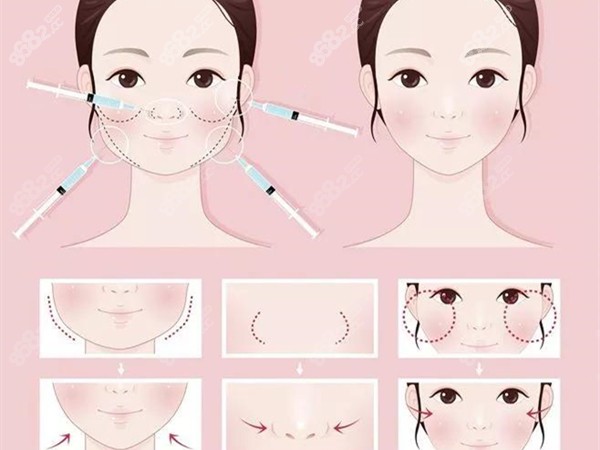 韩国俪伴的面部吸脂+埋线提升优势