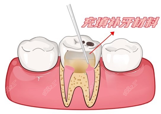 充填补牙材料