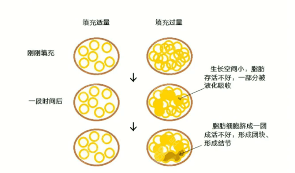 自体脂肪隆胸流程