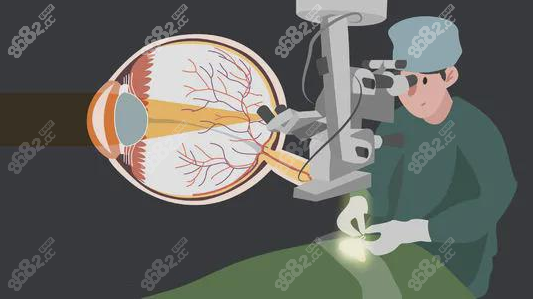 半飞秒近视眼手术
