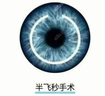 半飞秒手术