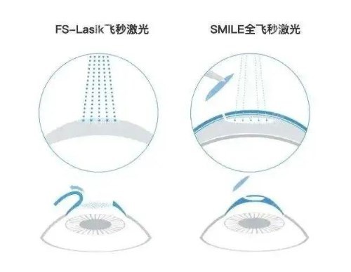 近视眼手术全飞秒和半飞秒区别