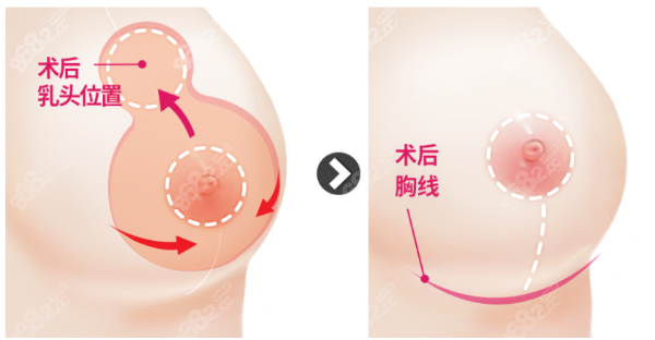 栗勇缩胸疤痕明显吗