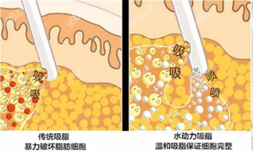 南京友谊整形李相旭医生吸脂手术口碑不错