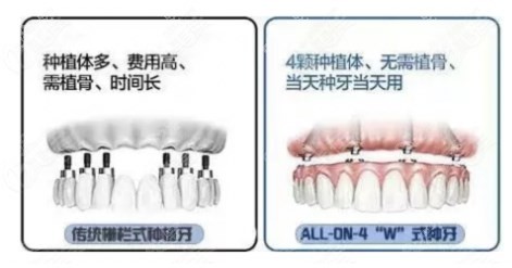 all-on-4即刻全口种植牙