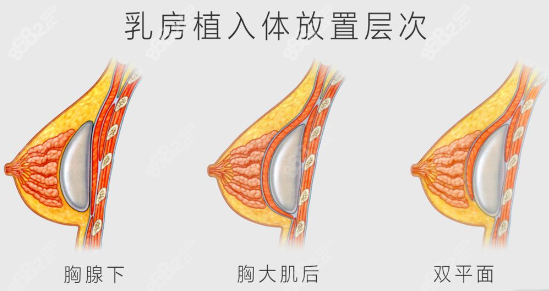 假体隆胸手术图示8682.cc