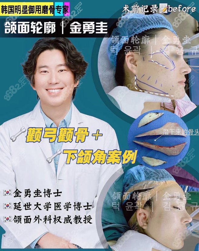 金勇圭磨骨实例：金勇圭颧骨颧弓+下颌角截骨术后即刻对比图