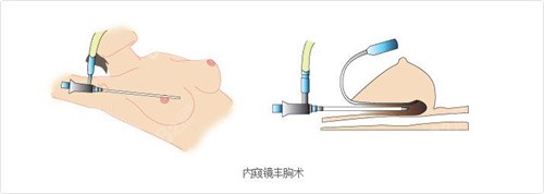 内窥镜丰胸腋下切口手术示意图