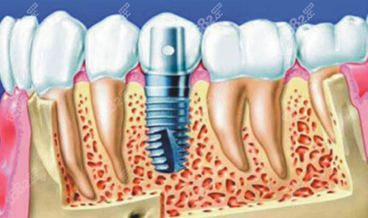 成都圣贝口腔医院种植牙