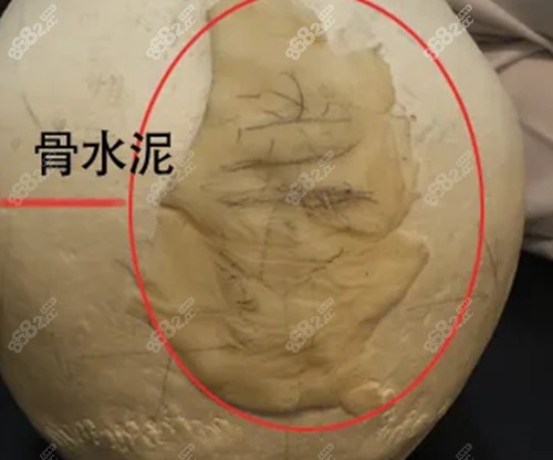 骨水泥靠谱吗？