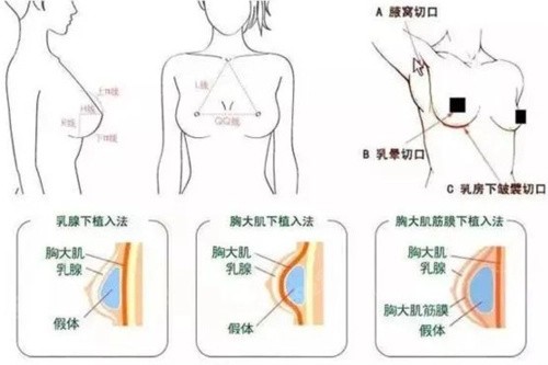 双平面隆胸的层次位置