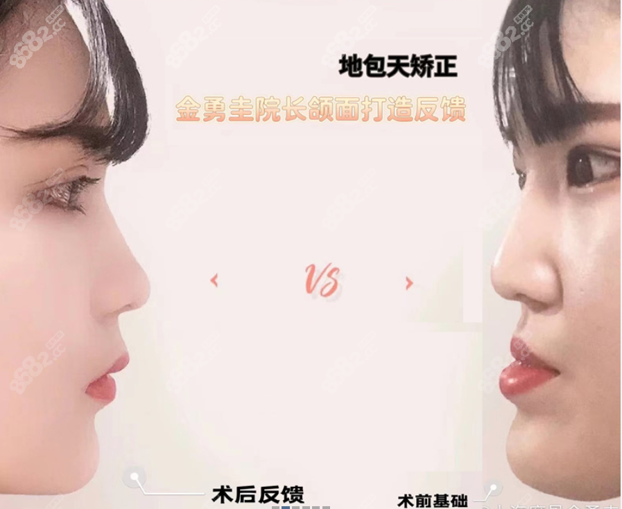 金勇圭双鄂手术怎么样