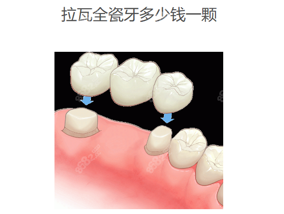 拉瓦全瓷牙多少钱一颗www.8682.cc