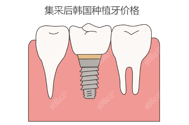 集采后韩国种植牙价格