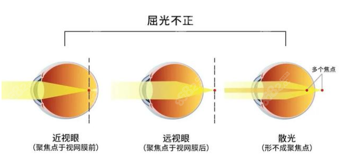 近视眼矫正价格8800元起8682.cc