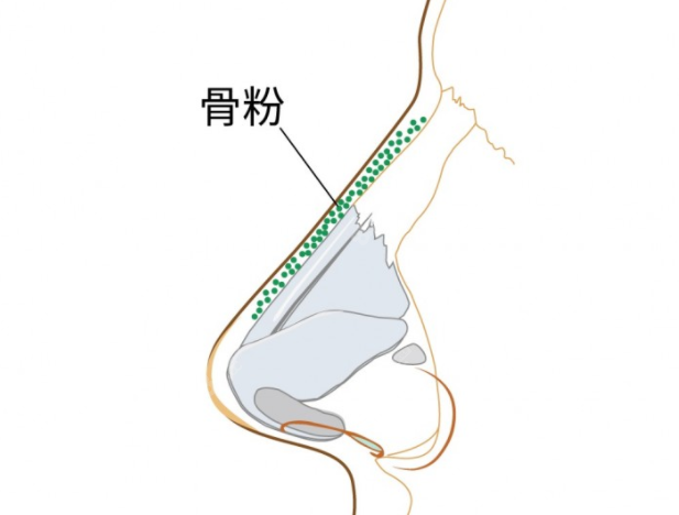 广州海峡整形取鼻子骨粉技术好