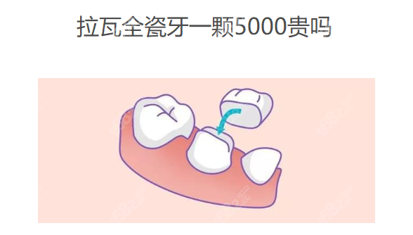 拉瓦全瓷牙一颗5000贵吗