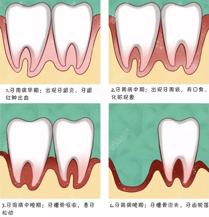 牙周病