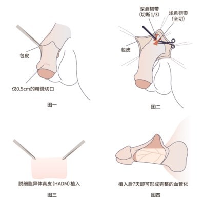 生物补片可以终身不取